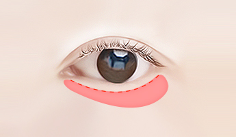 CDU Lower Blepharoplasty korea