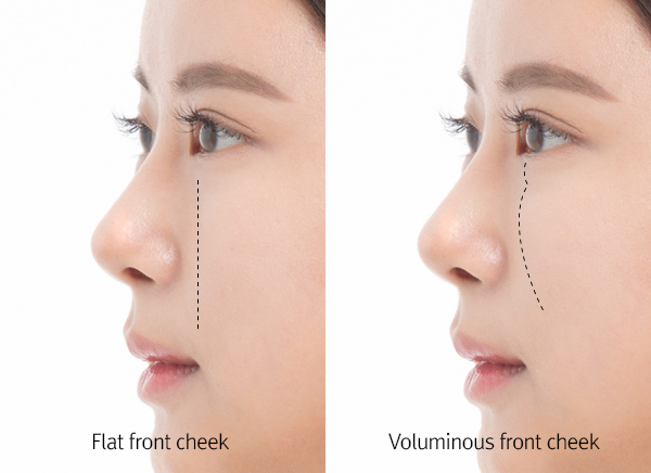 CDU Lower Blepharoplasty seoul