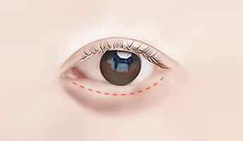 Lower Blepharoplasty gangnam