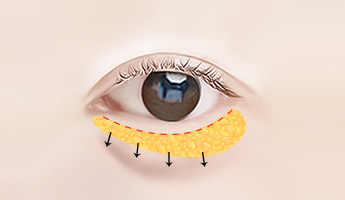 Lower Blepharoplasty korean eye plastic surgery