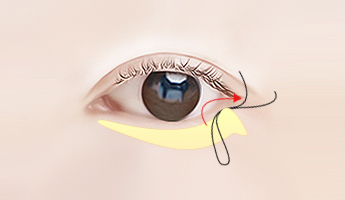 Lower Blepharoplasty south korean eye plastic surgery