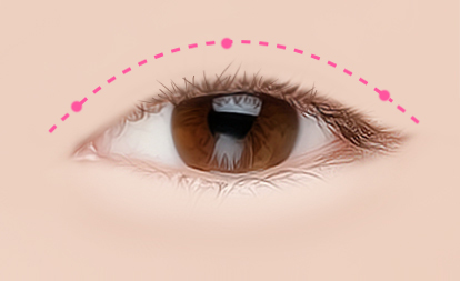 korean eyelid surgery