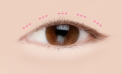 korean double eyelid surgery