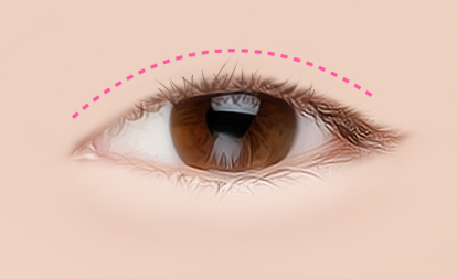 korea eyelid surgery