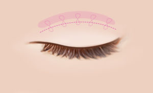 best eyelid surgery in korea