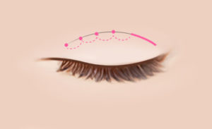 south korea double eyelid surgery