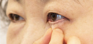 lower blepharoplasty eye surgery korea