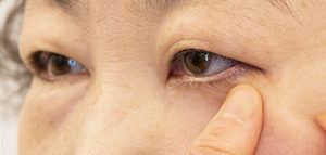 lower blepharoplasty eye surgery south korea