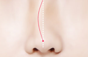 deviated nose surgery korea