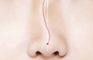 deviated nose surgery korea