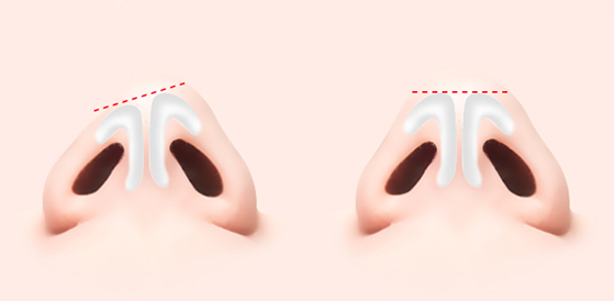 deviated nose surgery korea