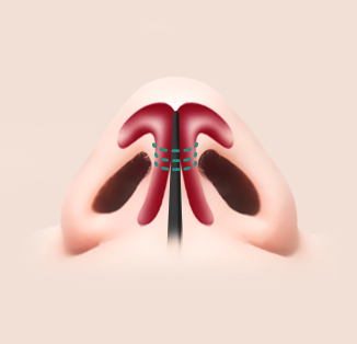 deviated nose surgery korea