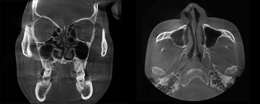 deviated nose surgery korea