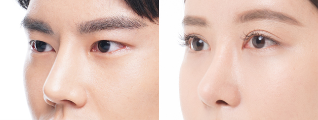 male rhinoplasty korea