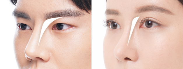 korean male rhinoplasty