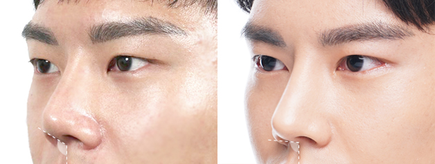 men plastic surgery korea