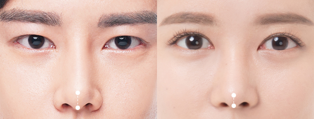 men plastic surgery korea