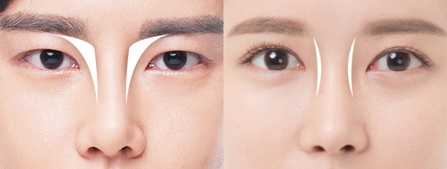 male rhinoplasty korea