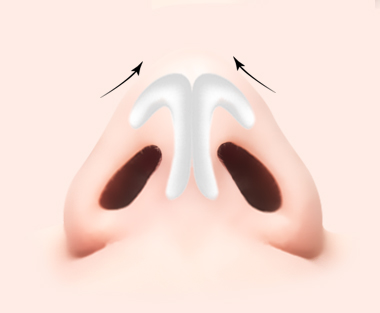 nose plastic surgery in korea