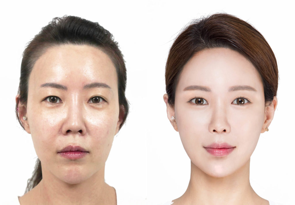 south korea plastic surgery before and after