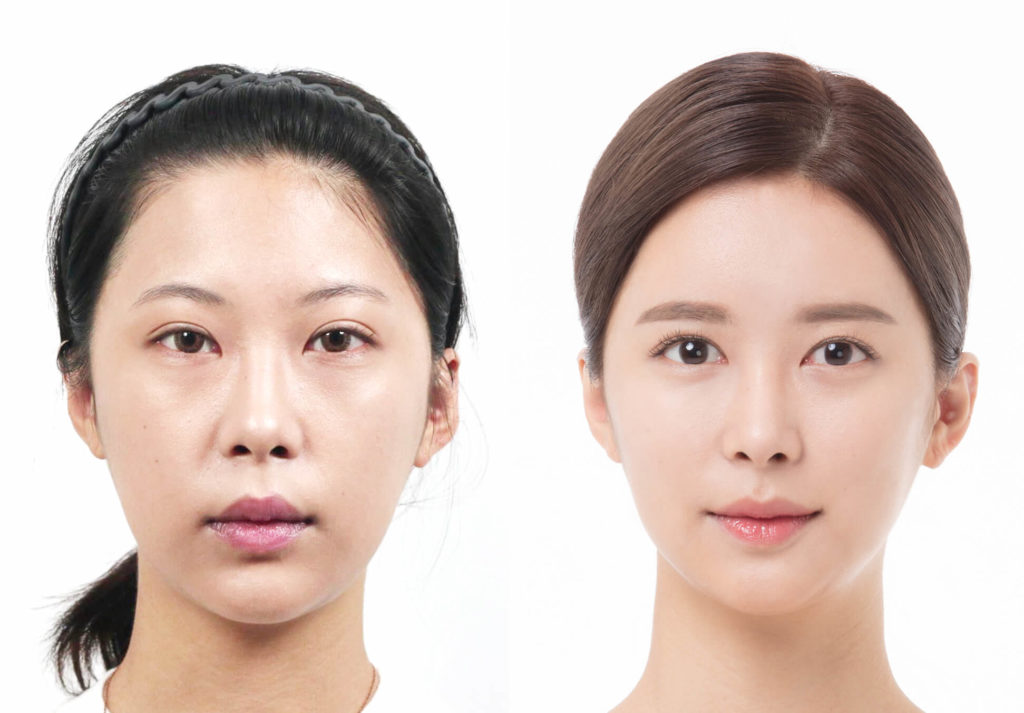 seoul cosmetic surgery