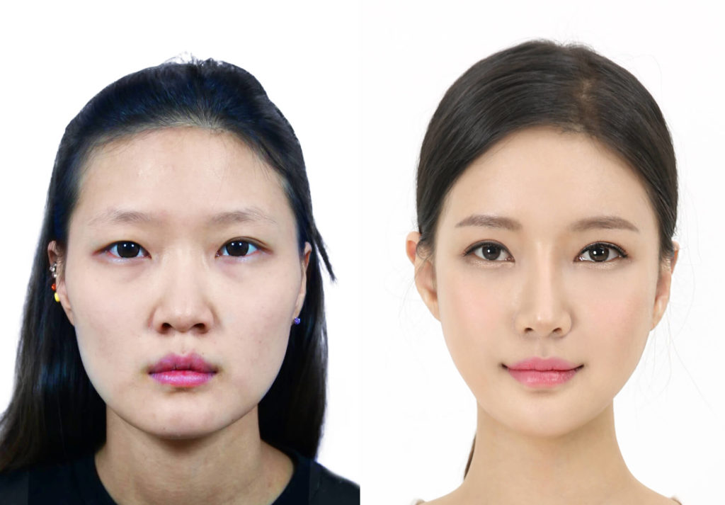 jaw surgery korea