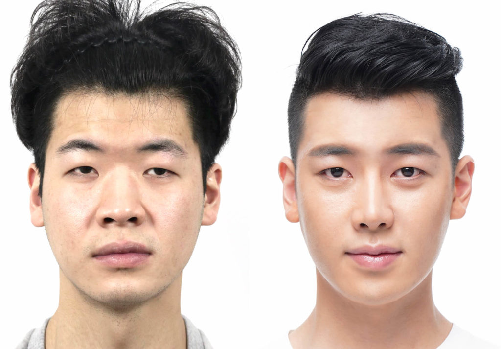 nose job cost in korea