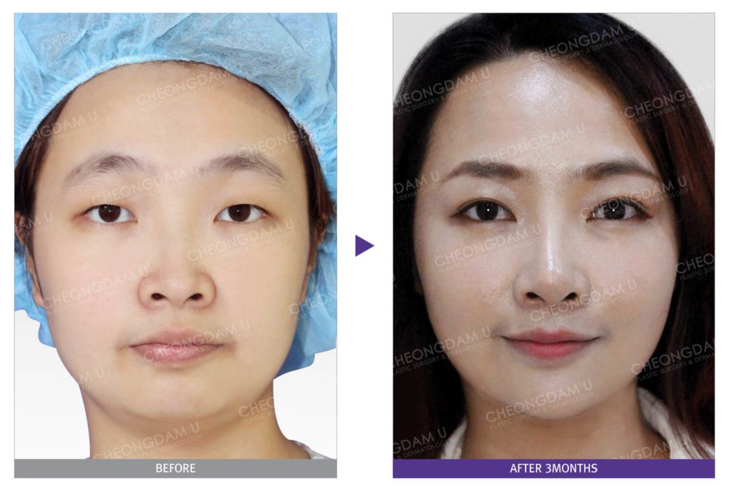 rhinoplasty