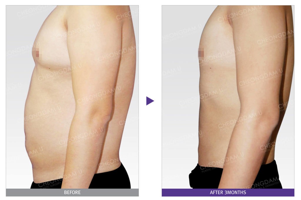 liposuction-abdomen-ab