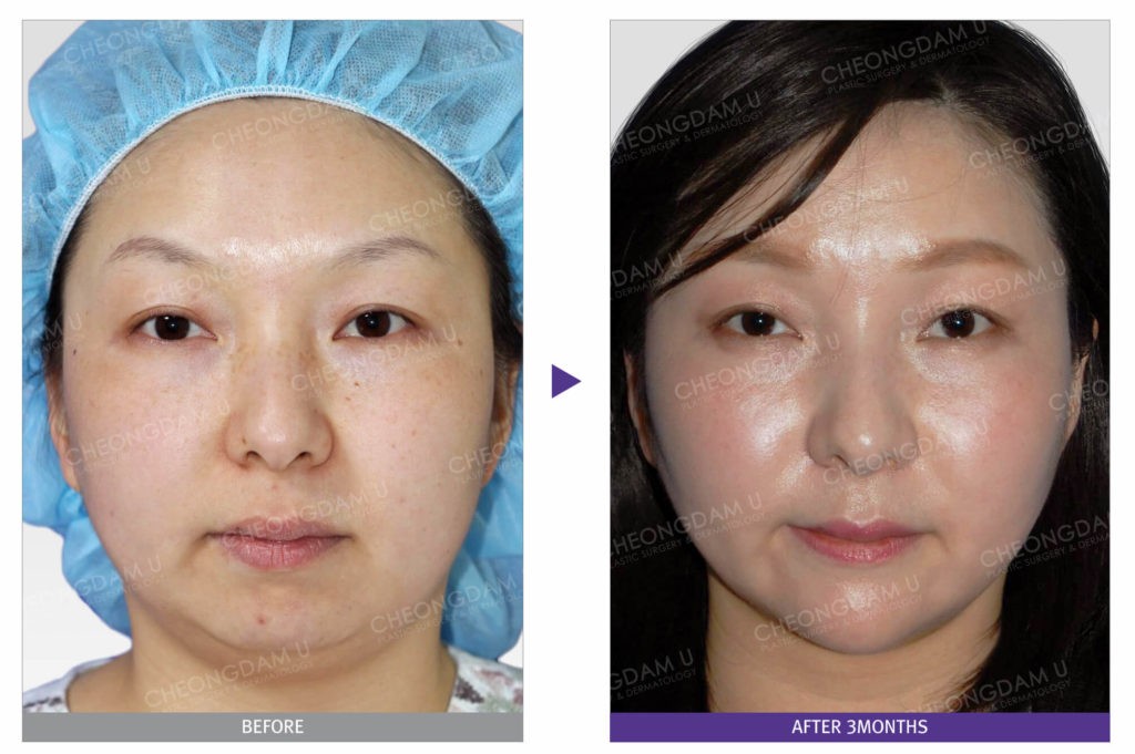 jaw-reduction-liposuction-doublechin