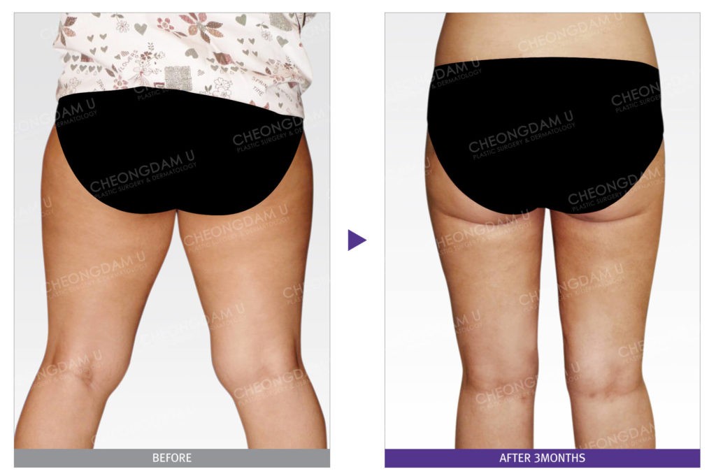 liposuction-thigh