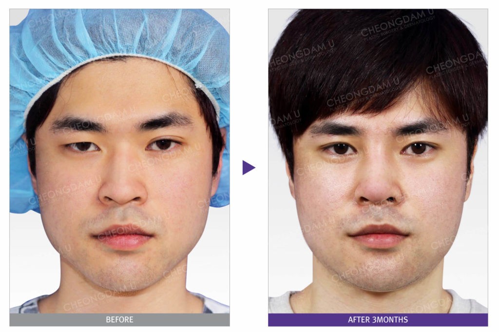 male-rhinoplasty