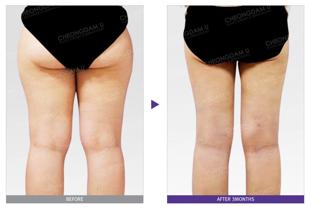 thigh-liposuction-back