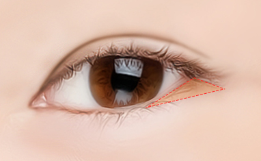 canthoplasty surgery korea