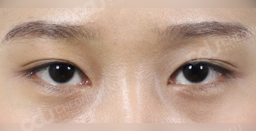 bigger eye surgery korea