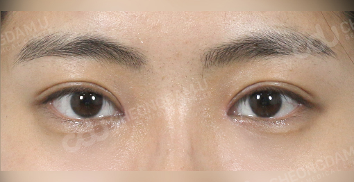 Canthoplasty korea