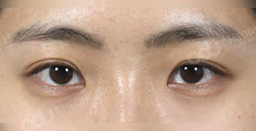 Canthoplasty korea