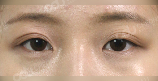 korean canthoplasty